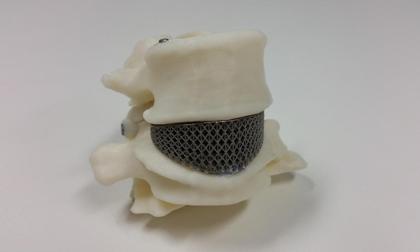 Joint effort produces Australia's first 3D printed spine ...