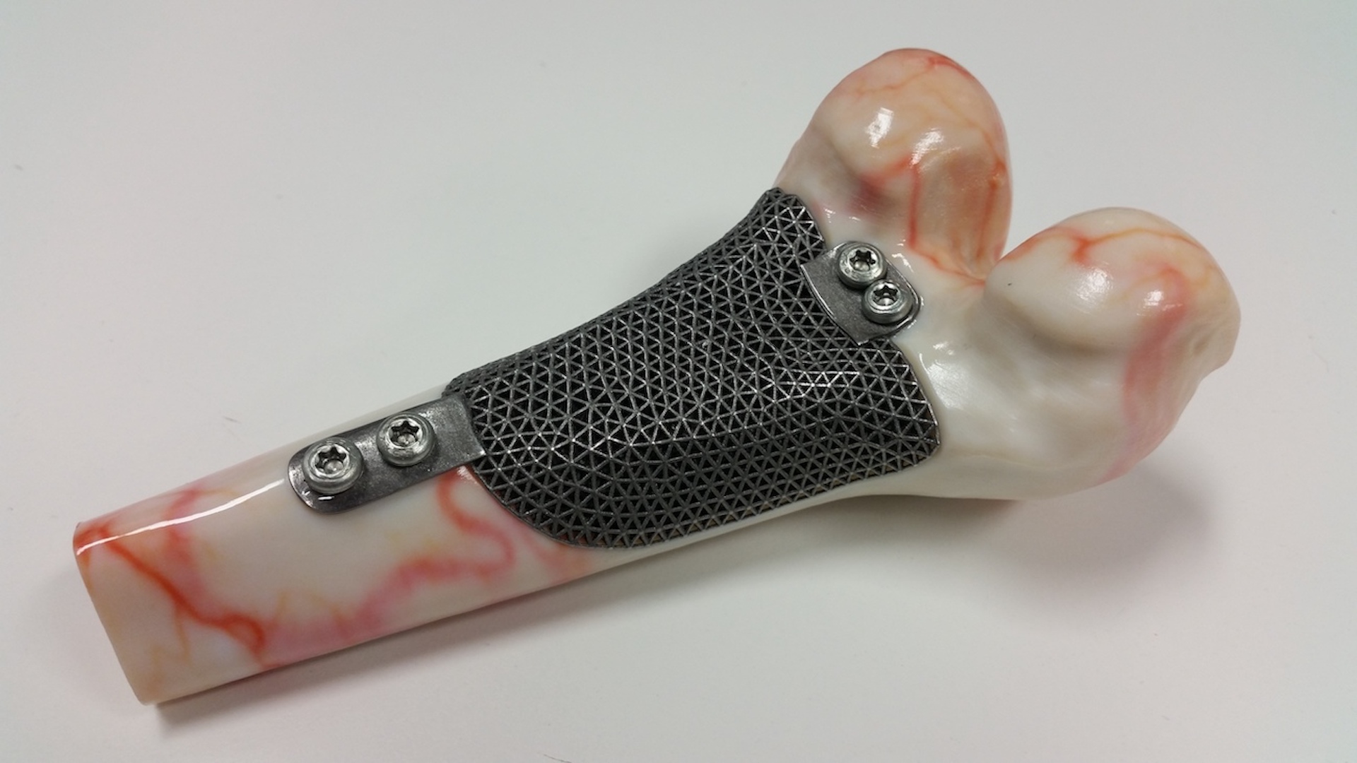 femur-with-lattice-implant.jpg